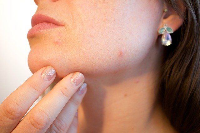 Gunakan Biotechnological Molecule, Intip Manfaat Acne Spot Gel Trueve