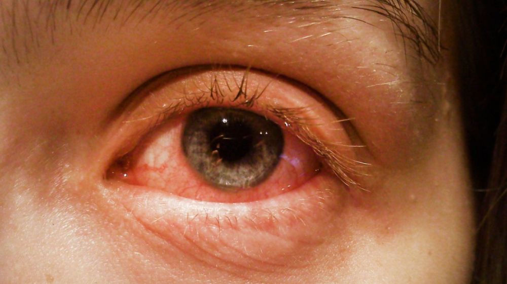 7 Penyakit Mata yang Kamu Perlu Tahu, Apa Saja? 
