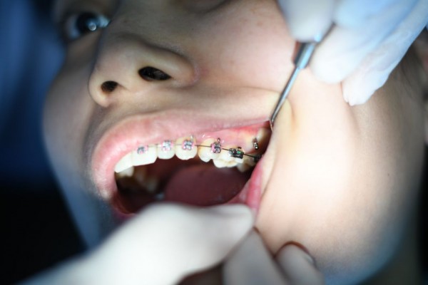 5 Masalah Umum Pengguna Kawat Gigi dan Cara Mengatasinya