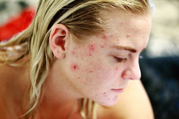 9 Bahan untuk Perawatan Jerawat Terbaik Menurut Pakar Dermatologi