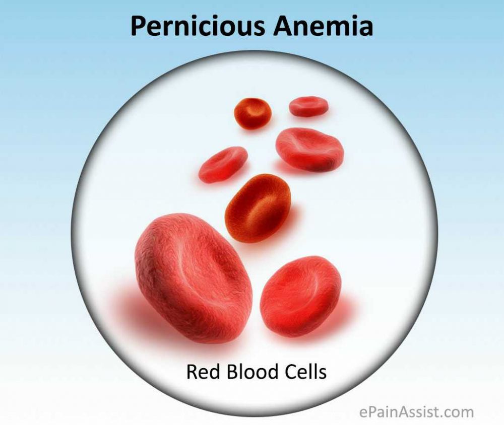 Anemia Pernisiosa: Gejala, Diagnosis, Dan Pengobatan