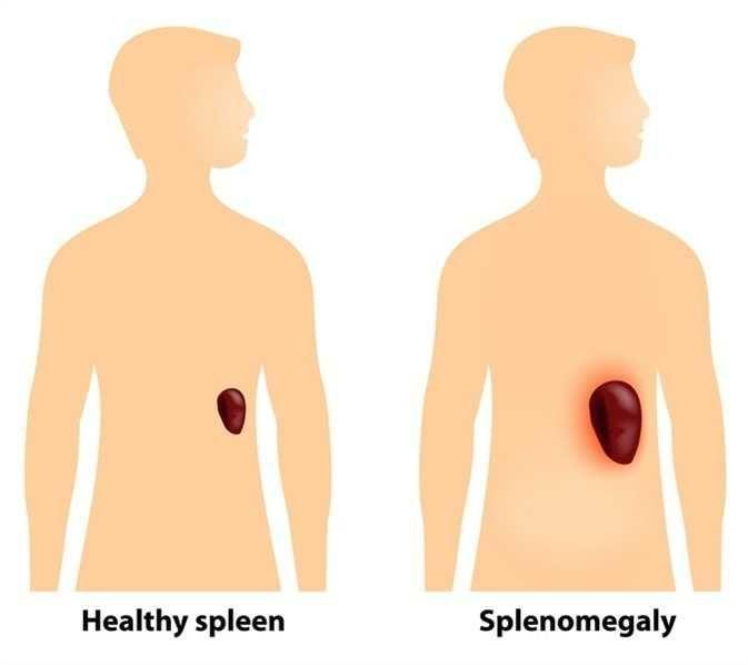 splenomegali-penyebab-gejala-diagnosis-dan-pengobatan