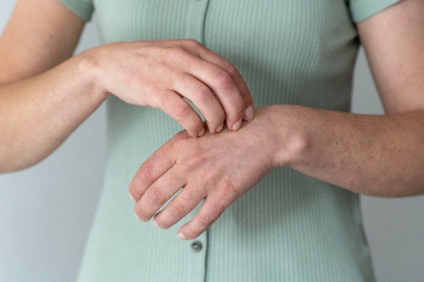 7 Fakta Solar Urticaria, Alergi Sinar Matahari yang Langka