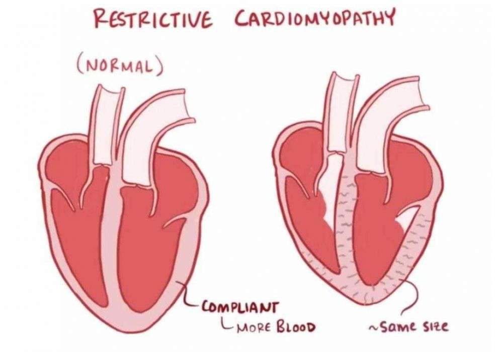 Kardiomiopati Restriktif: Penyebab, Gejala, Dan Pengobatan