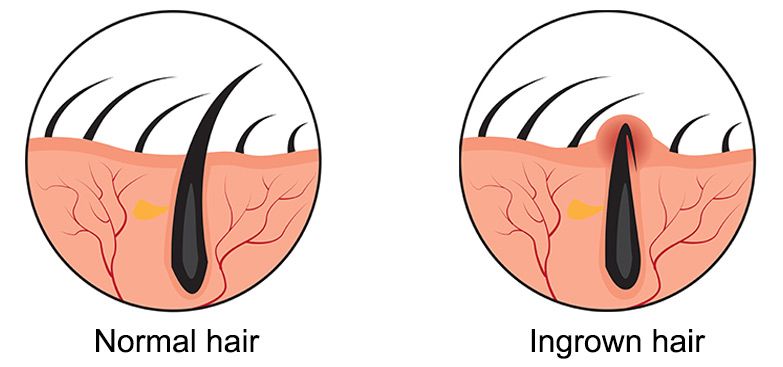 Mengenal Ingrown Hair, Kondisi Rambut Tumbuh ke Dalam Kulit