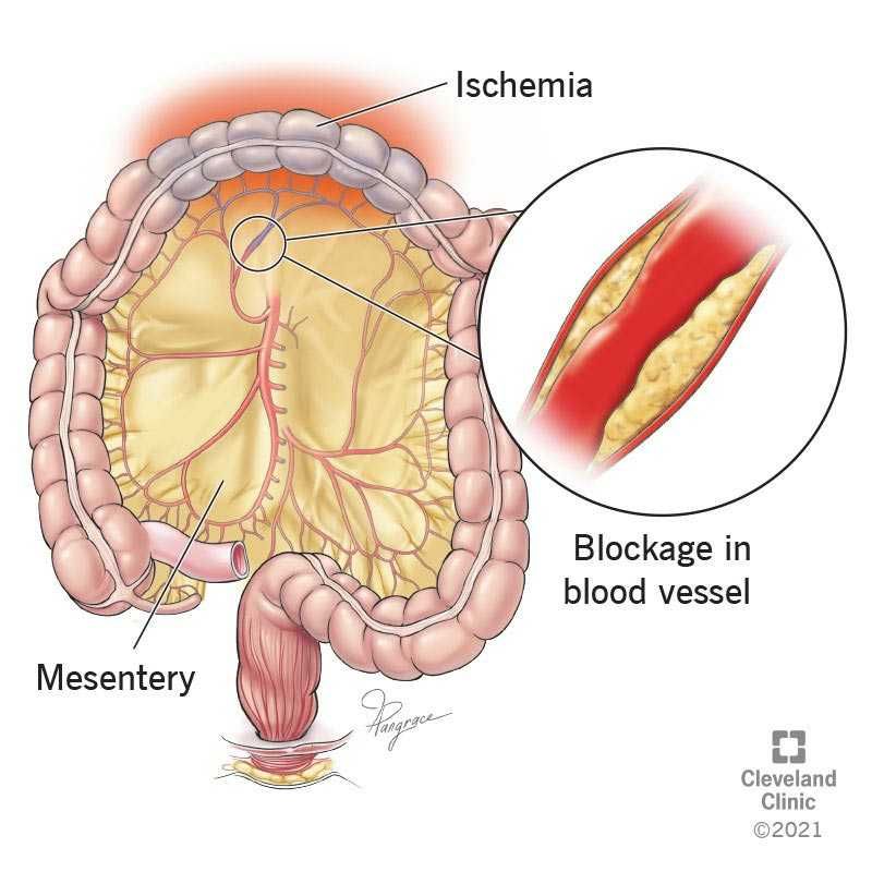 iskemia-mesenterika-penyebab-gejala-pengobatan