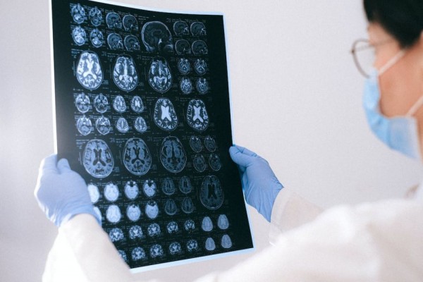 Mengenal Penyakit Prion, Kelainan Otak Langka yang Mematikan