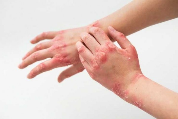 Penyakit Sifilis di Tabanan Didominasi Perempuan