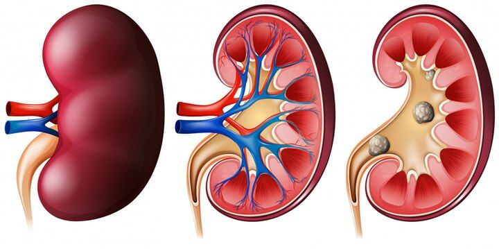 Azotemia: Penyebab, Gejala, Komplikasi, dan Pengobatan