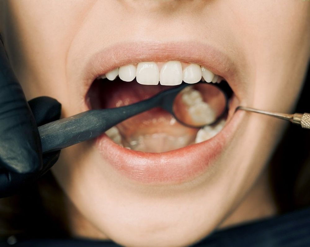 Gigi Berlubang Termasuk Masalah Kesehatan Mulut yang Banyak Terjadi