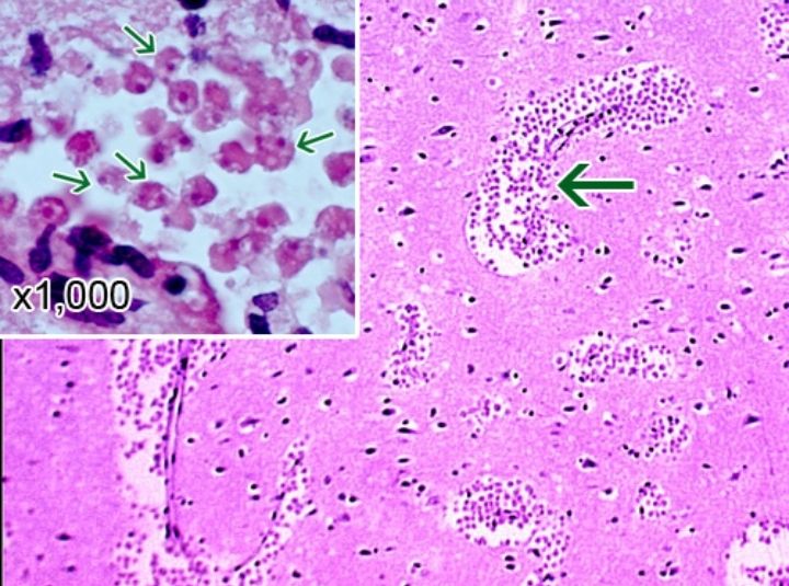 Mengenal Bakteri Pemakan Otak Manusia, Naegleria Fowleri