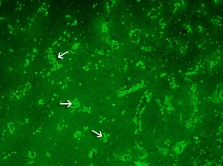 Mengenal Bakteri Pemakan Otak Manusia, Naegleria Fowleri