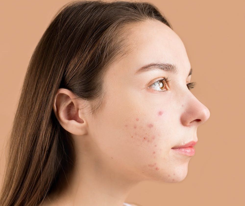 5 Tanda Kamu Mengalami Alergi Skincare, Segera Hentikan!