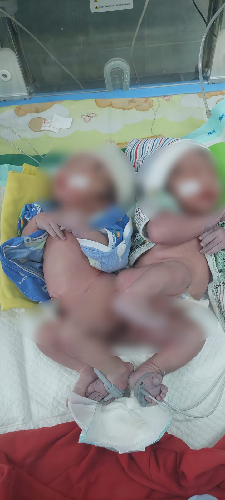 Para Dokter Spesialis di RSUD Tulungagung Pantau Bayi Kembar Siam