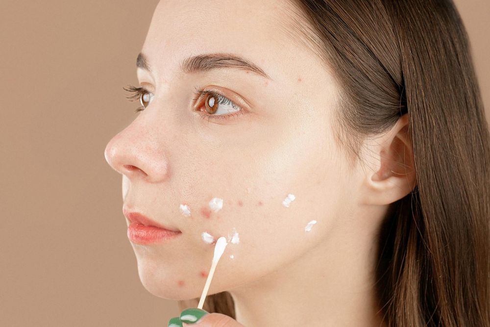 8 Efek Samping Obat Jerawat Tretinoin