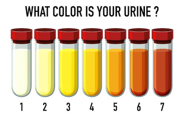 7 Warna Urine Jadi Penanda Baik Buruknya Kesehatan