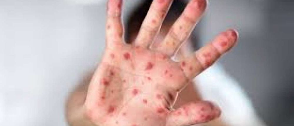 Dinkes Sulawesi Utara Bantah Penyakit Mpox Masuk Manado