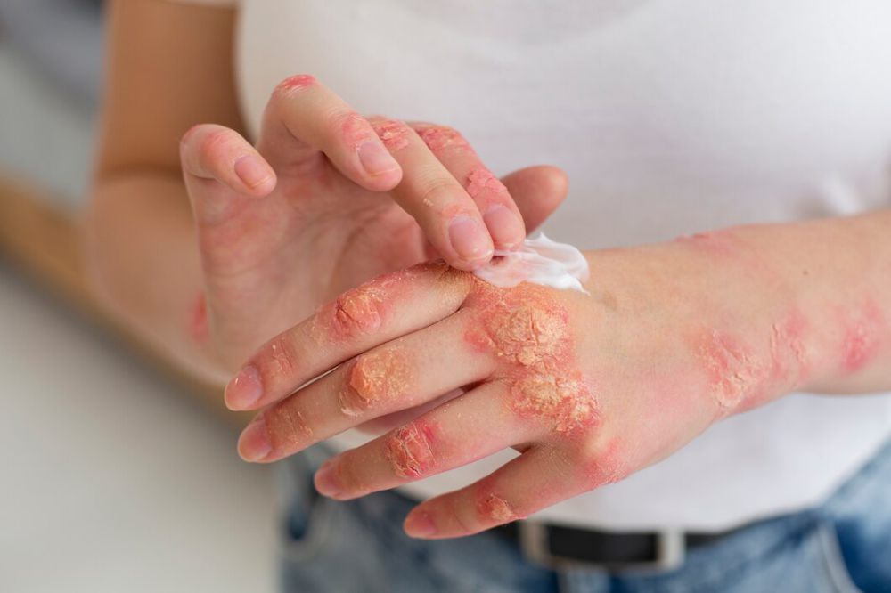 5 Dampak Buruk Rokok Terhadap Kesehatan Kulit, Bisa Psoriasis!