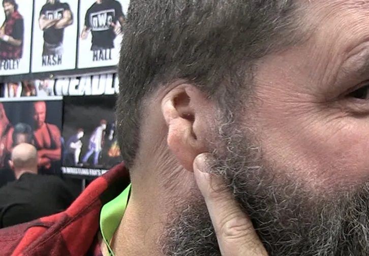 Bagaimana Mick Foley WWE Kehilangan Telinganya?