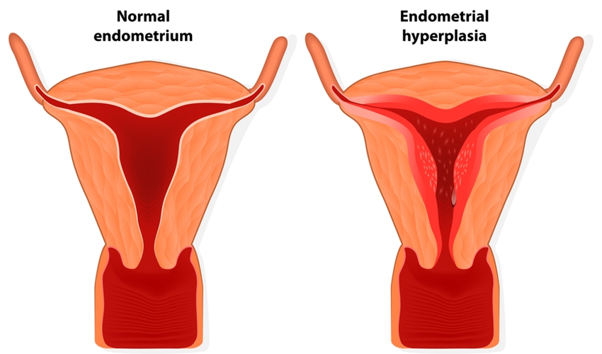 endometriosis-conceptfertilitycouk-ee5144c6f95b2cd37b1545c984d9f289.jpg
