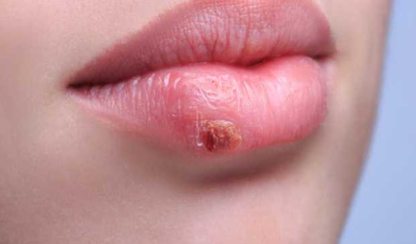 herpes-ad539ff4222a335a0d267334b579beb6.jpg