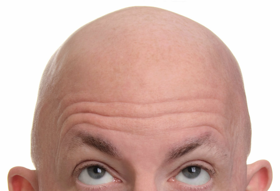  Kenapa  Bisa Ada Rambut  Uban dan Botak Ini Jawaban Ilmiahnya