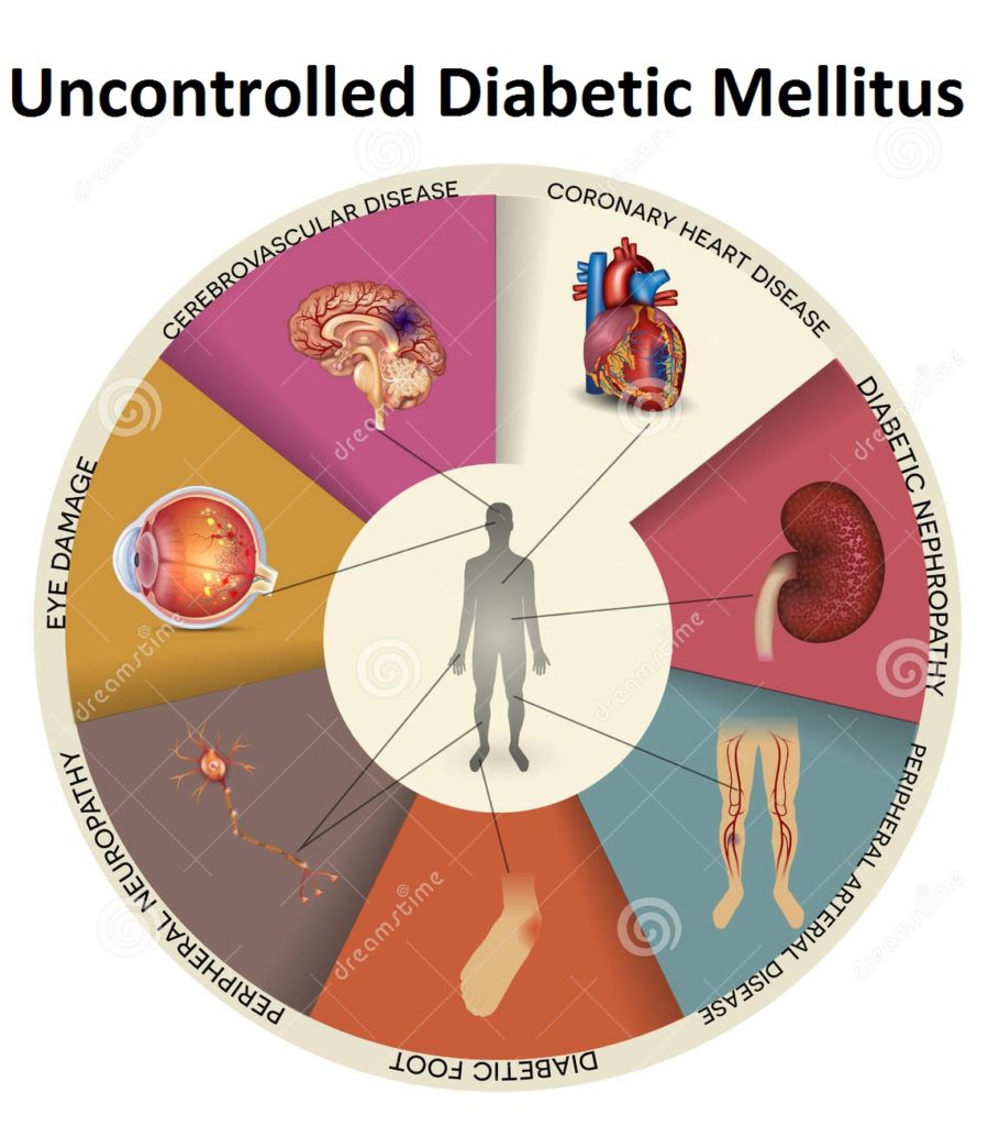 4 Jenis Diabetes Melitus, Nomor 3 Tak Dianjurkan Puasa