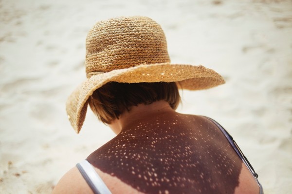 Mudah Dicoba, 8 Cara Aplikatif Selamatkan Kulit dari Sunburn