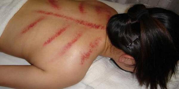 Apa Benar Kerokan Itu Berkhasiat untuk Kesehatan? Ini Jawaban Ahli!