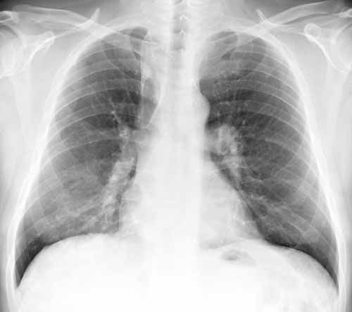 7 Tanda Ini Mungkin Indikasi Pneumonia, Tak Sekadar Batuk