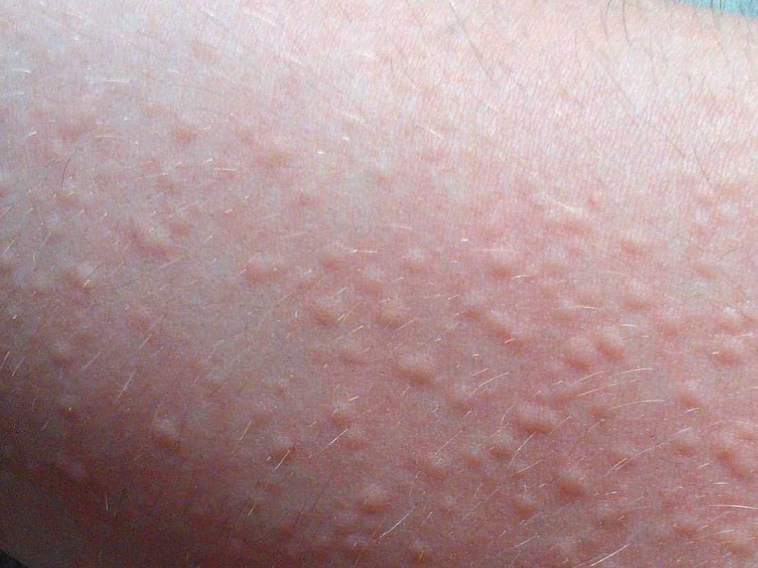 Ruam Kulit Setelah Olahraga Mungkin Kamu Kena Cholinergic Urticaria