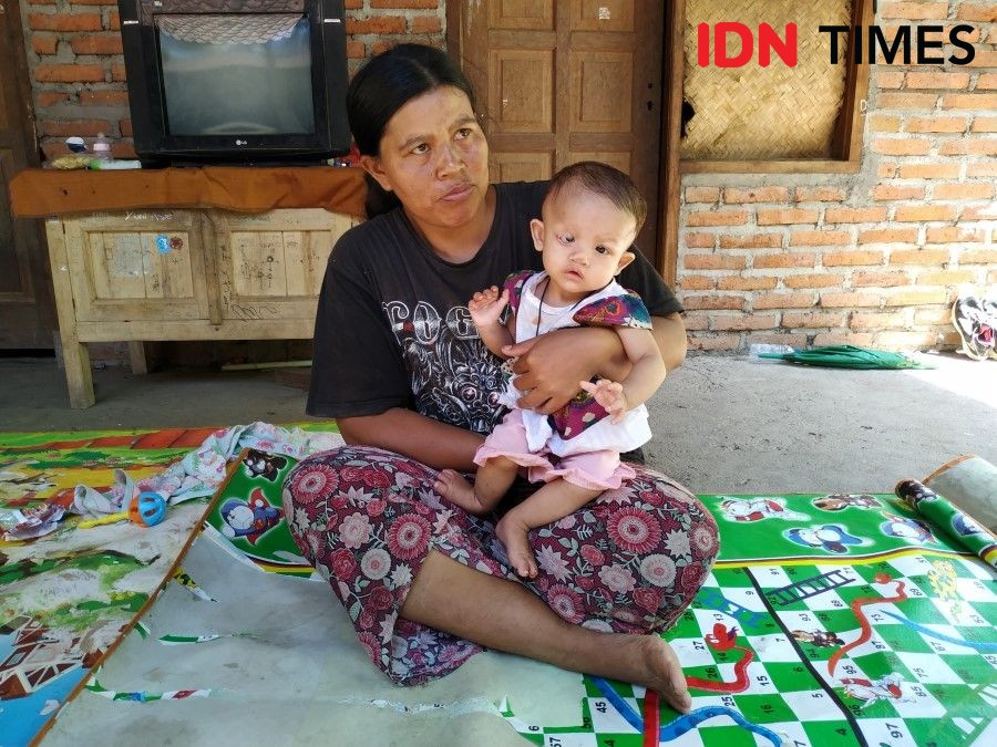 Kisah Bayi 8 Bulan di Klungkung, Terlahir Tanpa Lubang Anus & Kelopak