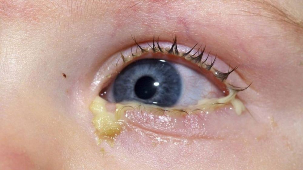 Macam Penyakit Mata yang Umum