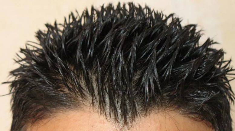 Penyebab Rambut Berketombe, Ini 7 Faktor Yang Sering Diabaikan