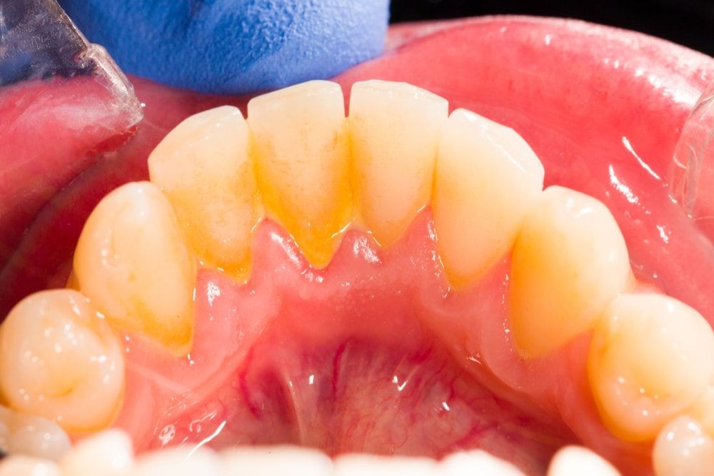 9 Perawatan Gigi Saat Puasa di Bulan Ramadan yang Dibolehkan dan Tidak