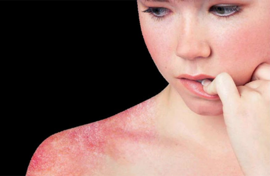 Penyakit Lupus: Info Gejala dan Penyebabnya