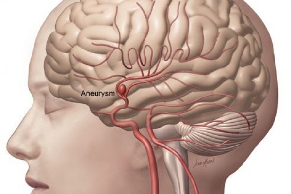 Kenali Bedanya Stroke Dan Heat Stroke