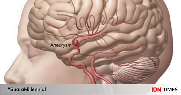 7 Fakta Tentang Aneurisma Yang Perlu Kamu Tahu
