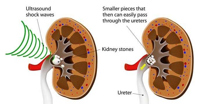 7 Cara Menyembuhkan Batu Ginjal, Sayangi Salah Satu Organ Vitalmu Ini!