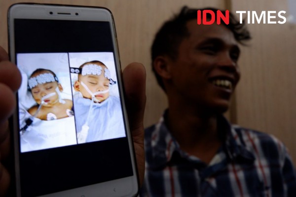 Pemisahan Kembar Adam dan Malik Berhasil, Perjuangannya Jadi Inspirasi
