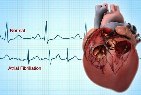 7 Fakta Fibrilasi Atrium, Detak Jantung Tak Teratur Penyebab Stroke