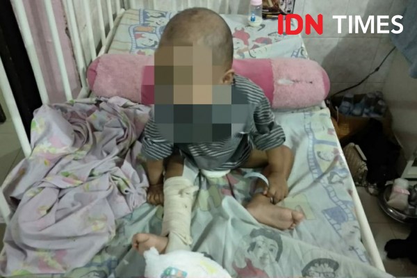 Bocah Tiga Tahun di Samarinda Disiksa Ibu Kandung hingga Patah Kaki