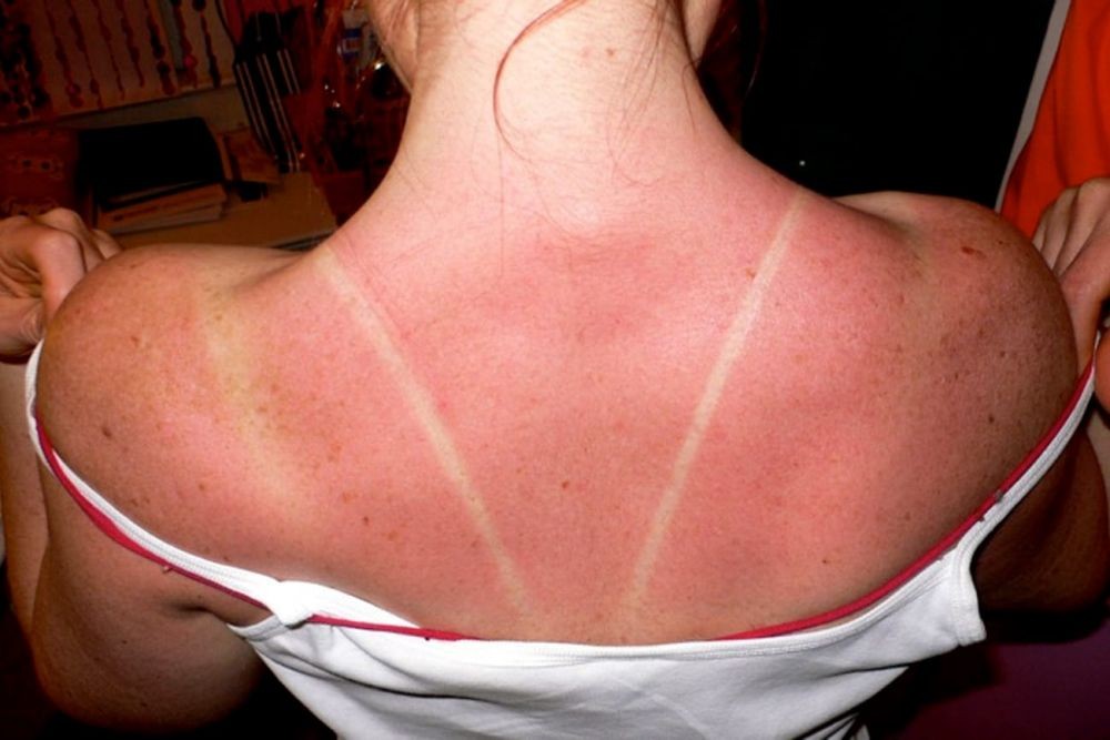7 Fakta Penting Sunburn Kulit Yang Terbakar Matahari 2119