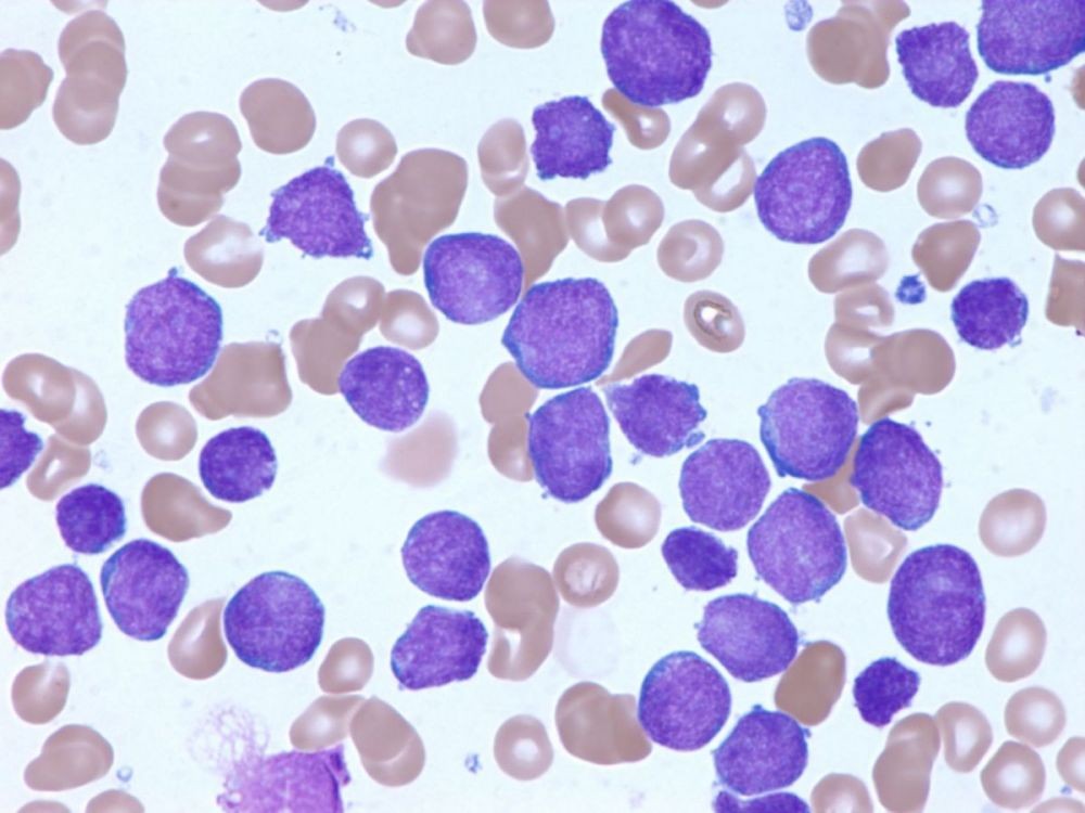 8 Penyakit Penyebab Gusi Berdarah, Bisa Tanda Leukemia