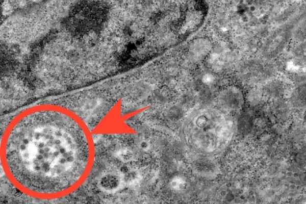 Begini Penampakan Virus Corona Ketika Masuk ke Tubuh Manusia