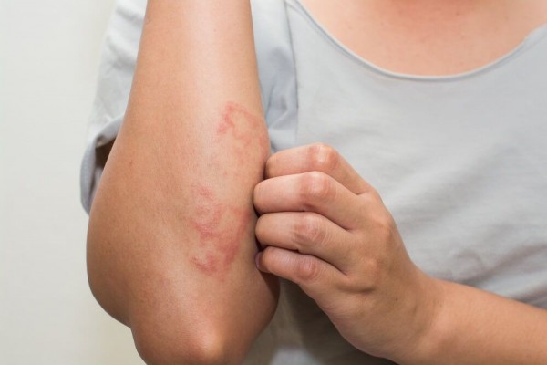 7 Penyebab Alergi yang Paling Umum, dari Debu hingga Makanan