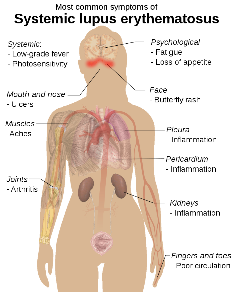 6 Fakta Penyakit Autoimun Lupus Eritematosus Sistemik Wajib Tahu