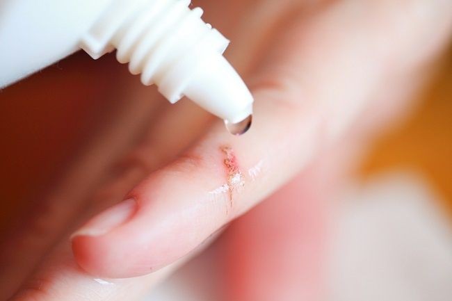 5 Cara Menangani Luka Tubuh, Jangan Sepelekan Walau Berukuran Kecil