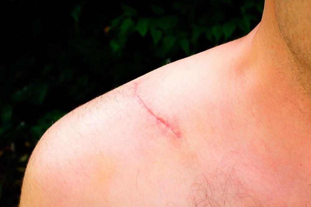 5 Cara Menangani Luka Tubuh, Jangan Sepelekan Walau Berukuran Kecil