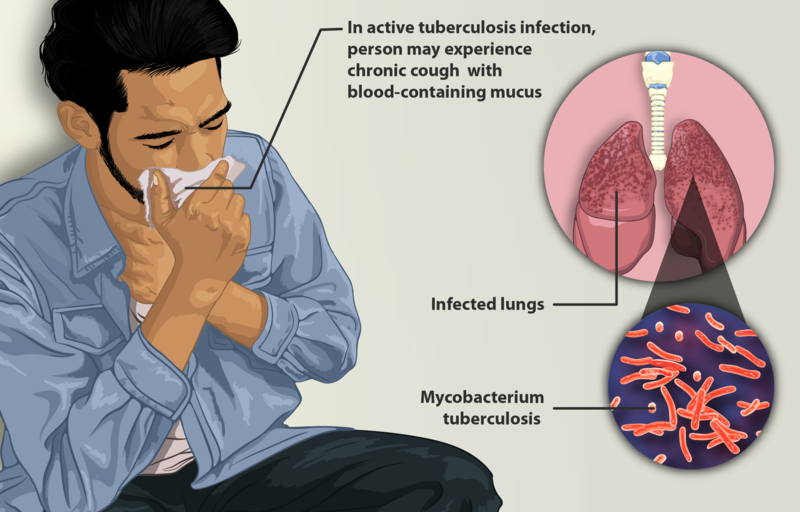 Akses Medis Minim Selama Pandemik, Penderita TBC Diselimuti Ketakutan 